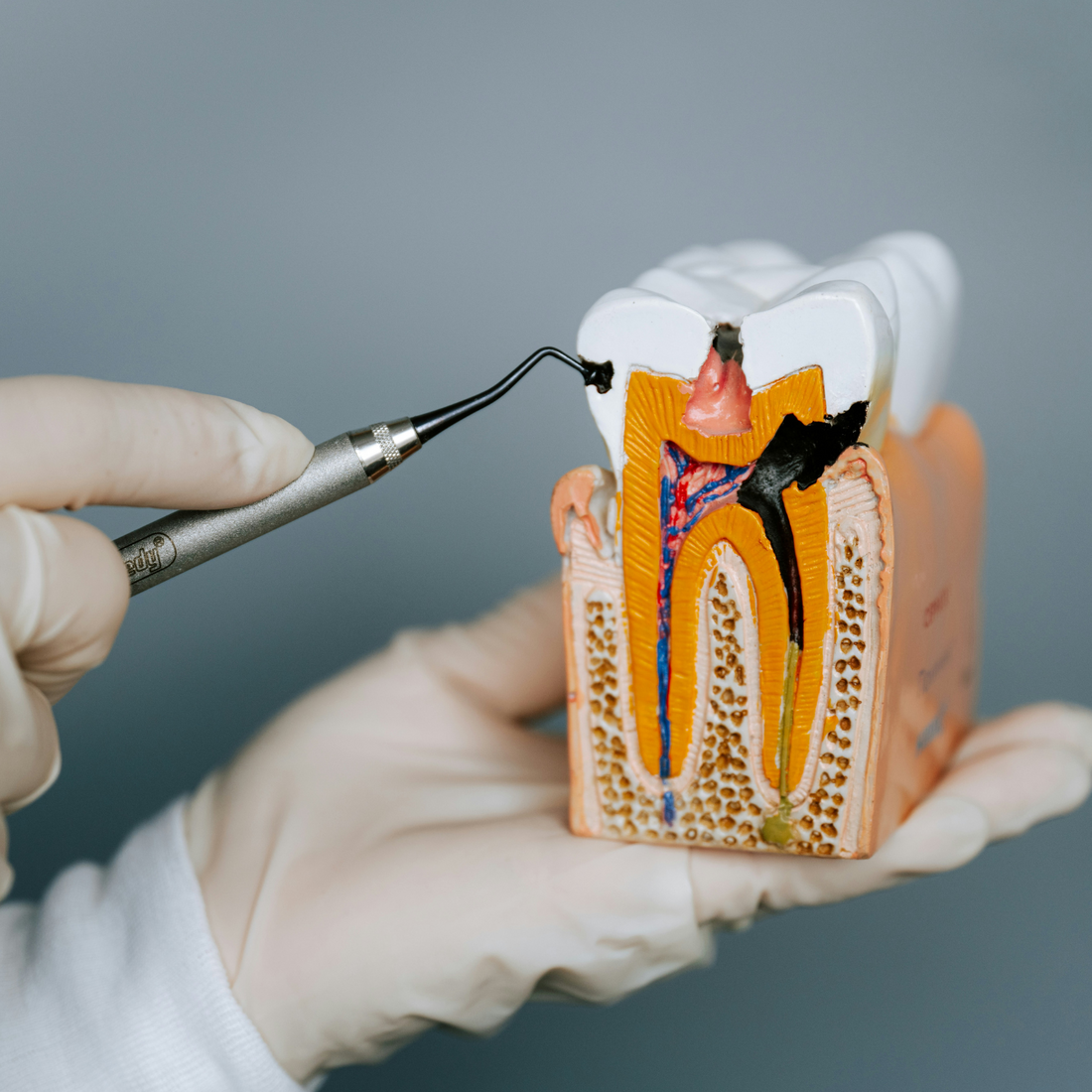 Le blanchiment dentaire abîme-t-il vraiment l'émail ? On sépare le vrai du faux.