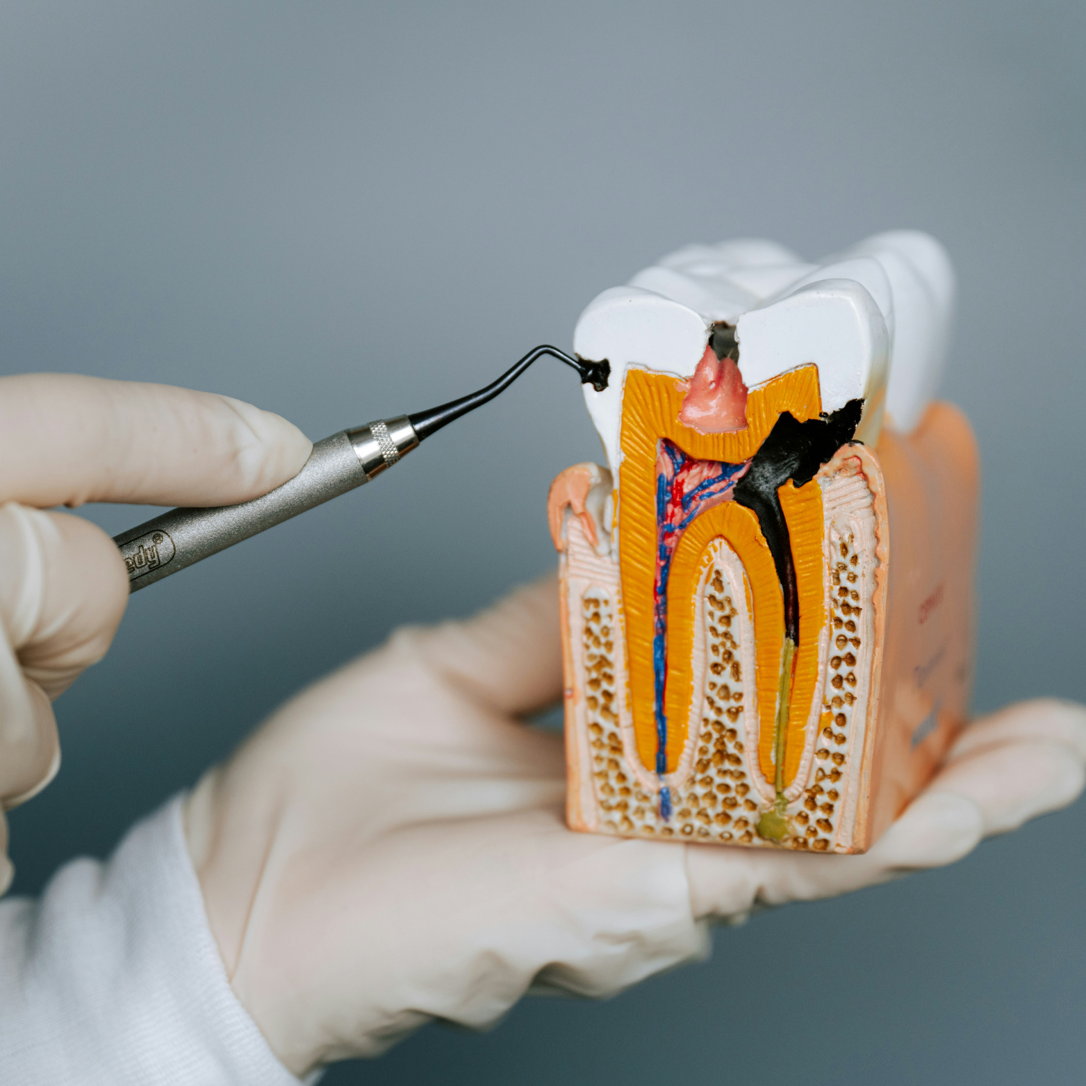 Le blanchiment dentaire abîme-t-il vraiment l'émail ? On sépare le vrai du faux.